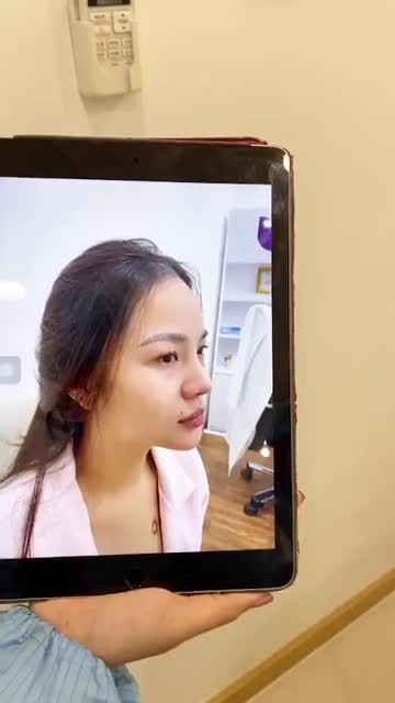 Gương mặt sắc nét, thu hút sau khi nâng mũi Sline cao