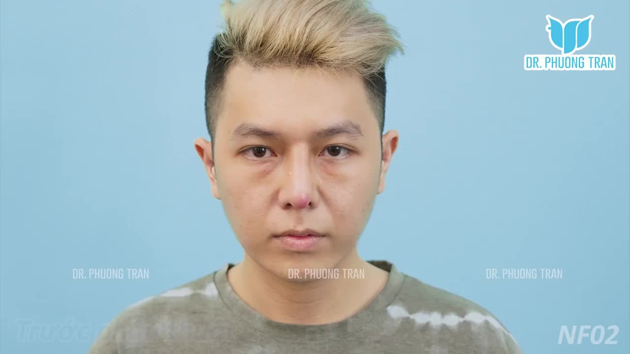 HÀNH TRÌNH 3 THÁNG ĐẶT TRUNG BÌ MỠ KHẮC PHỤC MŨI BỊ VIÊM, BÓNG ĐỎ