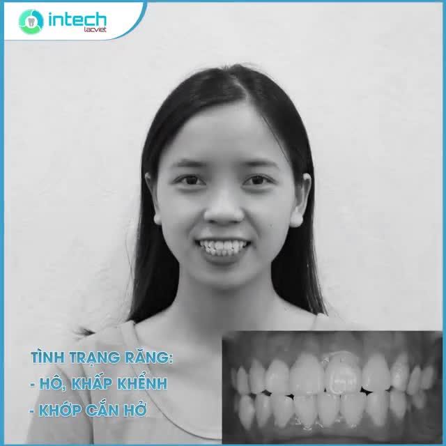HÀNH TRÌNH THÁO MẮC CÀI CỦA KHÁCH HÀNG NGUYỄN THỊ GIANG 1995