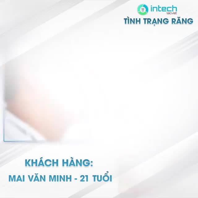 HÀNH TRÌNH THAY ĐỔI TRONG 11 THÁNG CỦA KHÁCH HÀNG NIỀNG RĂNG MẮC CÀI