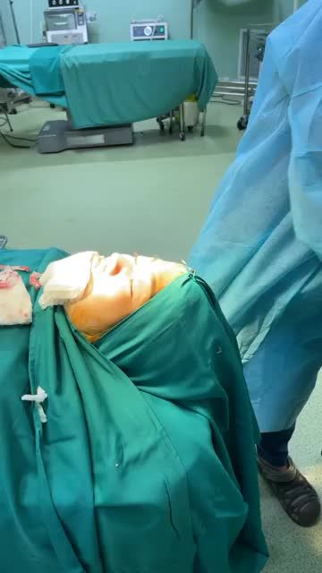 HÌNH ẢNH THỰC TẾ SAU NÂNG MŨI SIÊU CẤU TRÚC NANO