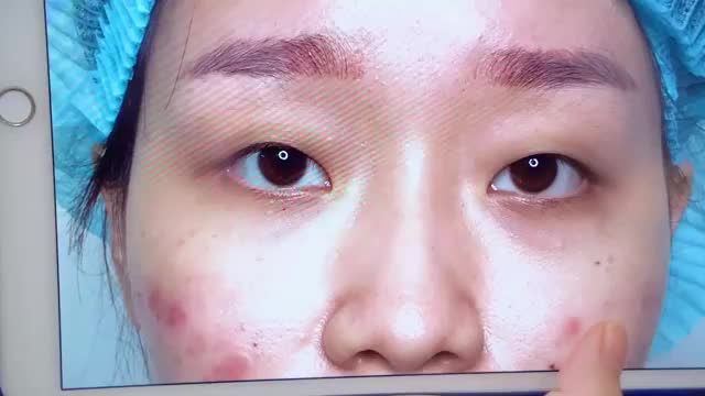 Hô biến mắt một mí thành 2 mí chỉ sau 30 phút bạn có tin? Cùng theo dõi kết quả sau đây để có câu trả lời
