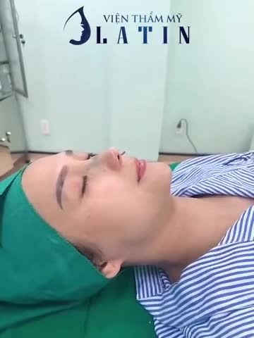 HÔ BIẾN MŨI LỖI BẨM SINH TRỞ NÊN ĐẸP HOÀN HẢO SAU 75 PHÚT