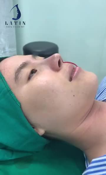 Hoàn thành ca mũi nâng bán cấu trúc cho em gái có nền mũi lệch bẩm sinh, sống mũi gồ.