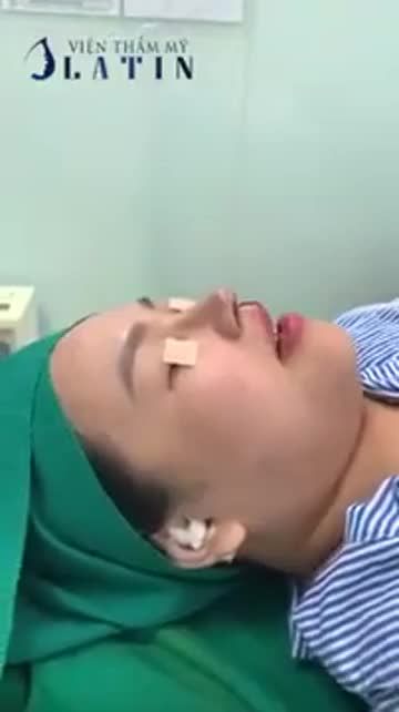 Hoàn thành xong ca nâng mũi cấu trúc megaderm thu nền xương, thu đầu mũi cho bạn khách hàng đến từ Hà Nội