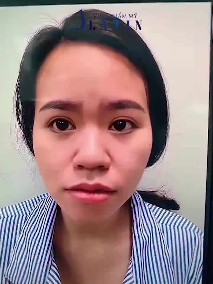 Hoàn thiện ca mũi cấu trúc kết hợp thu nhỏ đầu mũi và cánh mũi