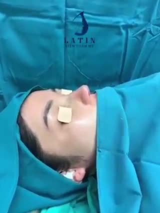 Hoàn thiện xong ca nâng mũi cấu trúc thu nhỏ đầu mũi, mời cả nhà cùng theo dõi kết quả.