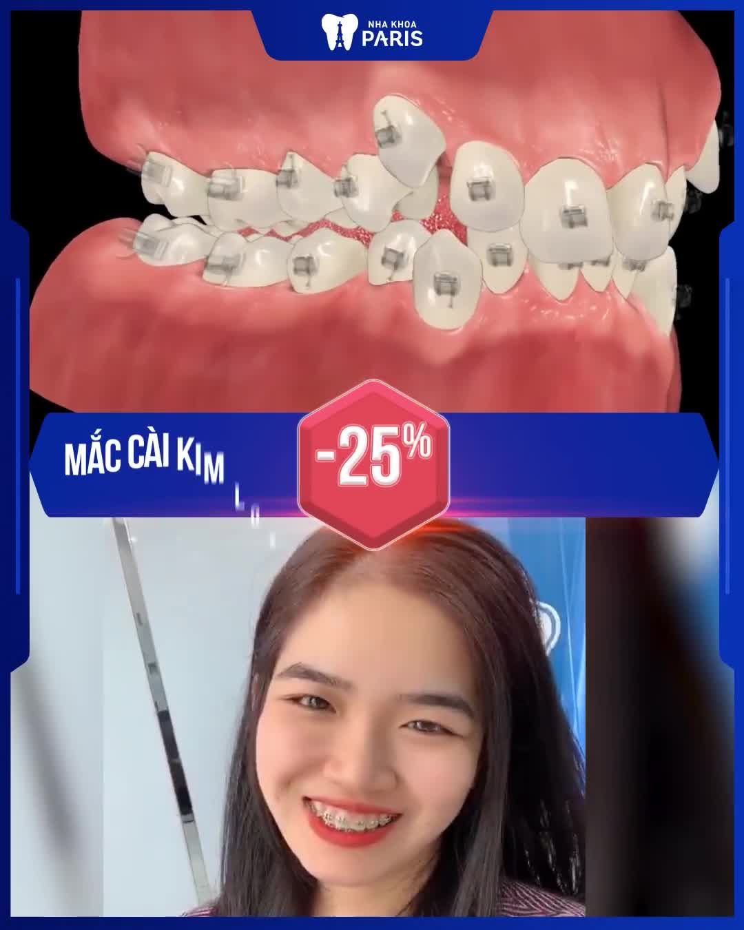 HOT 2021 - XU HƯỚNG NIỀNG RĂNG 4.0