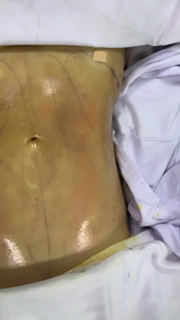 HÚT KIỆT MỠ BỤNG - NỔI RÕ CƠ