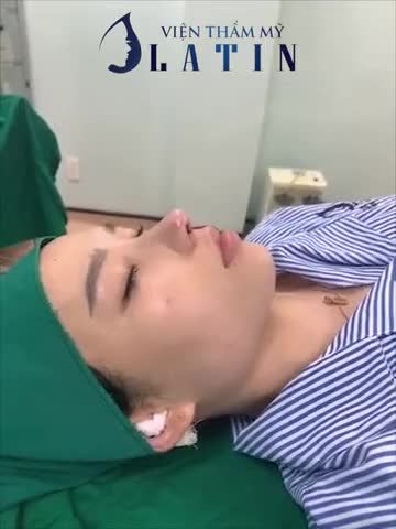KẾT QUẢ CA MŨI SỬA LẠI CẤU TRÚC cho em gái đã nâng mũi 8 năm trước, mũi to, lệch, lộ sóng, dáng mũi chưa cao bay, thon như em muốn.