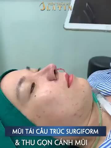 Kết quả ca mũi tái cấu trúc + cắt cánh mũi, xử lý mô xơ sau 2h30’ cho bạn gái đã từng nâng mũi 2 lần ở nơi khác nhưng không thành công.