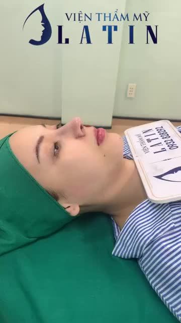 KẾT QUẢ CA MŨI TÁI CẤU TRÚC SỬA LẠI LẦN 2