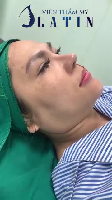Kết quả ca Nâng mũi Latin Có ngay dáng mũi mềm mại tự nhiên và hài hòa chỉ sau 60 phút thực hiện.