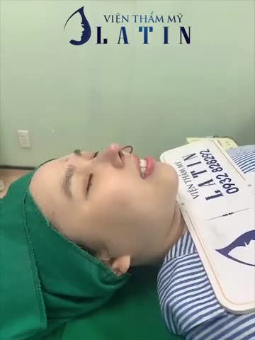 KẾT QUẢ CA SỬA MŨI TÁI CẤU TRÚC SAU 2 LẦN THẤT BẠI