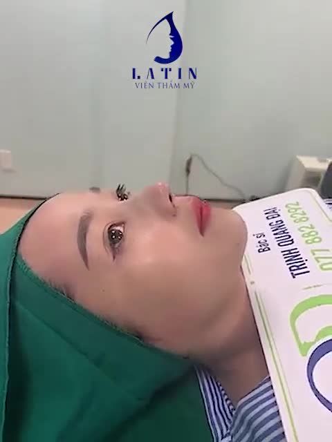 Kết quả hoàn thiện ca mũi bán cấu trúc thu nền xương Megaderm 2 lớp, thu cánh mũi mang lại diện mạo thanh tú, hài hoà, trẻ trung hơn.