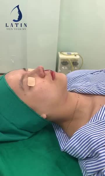 Kết quả nâng mũi bán cấu trúc, thu đầu mũi, chỉnh nền xương cho bạn gái trẻ. Mời cả nhà cùng theo dõi ạ