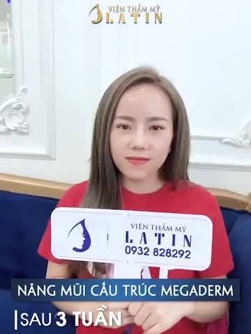 Kết quả nâng mũi cấu trúc dáng Latin sau 3 tuần, hôm nay ghé trung tâm tái khám.