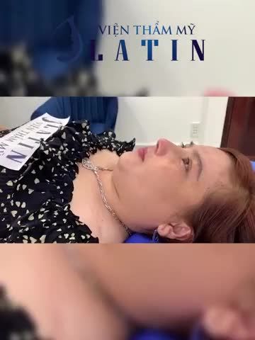 Kết quả Nâng mũi cấu trúc + Nâng cung mày tại Latin sau 10 ngày cắt chỉ. Mời cả nhà cùng chiêm ngưỡng nhé!