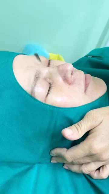 KẾT QUẢ SAU NÂNG MŨI CẤU TRÚC VỪA XONG