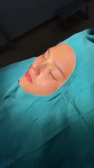 KẾT QUẢ SỬA MŨI LỖI CHO CHỊ KHÁCH ĐÃ NÂNG 2 LẦN TẠI CƠ SỞ KHÁC