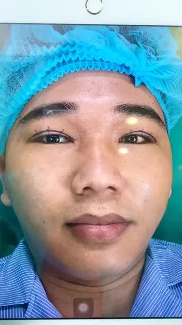 KẾT QUẢ TẠO HÌNH MẮT ĐẸP CHO NAM GIỚI