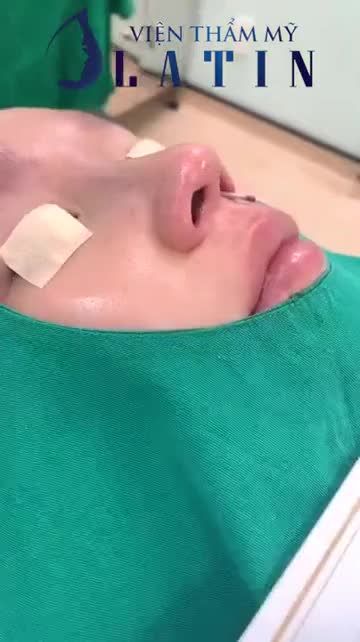 Khắc phục Mũi Tẹt - Đầu Mũi To - Hếch ngay sau 75 phút Nâng mũi