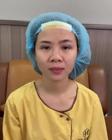Khách hàng cắt mí
