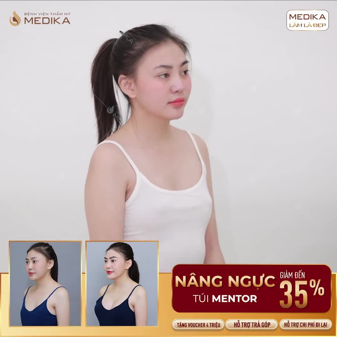 KHÁCH HÀNG NHÀ MEDIKA GIẢI ĐÁP THẮC MẮC KHI NÂNG VÒNG 1