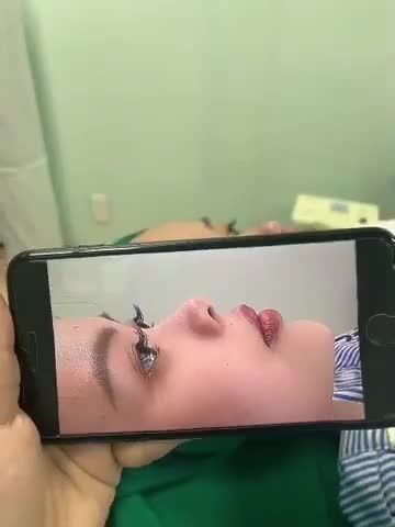 KHÁCH HÀNG XINH ĐẸP VỪA LÀM PHẪU THUẬT NÂNG MŨI XONG