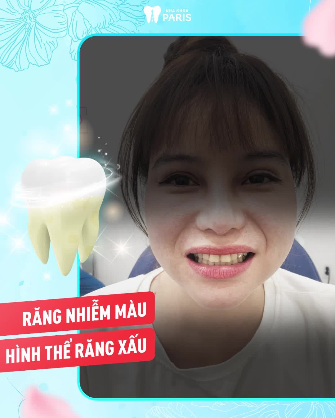 LÃO HÓA NGƯỢC SAU BỌC 21 SỨ CERCON