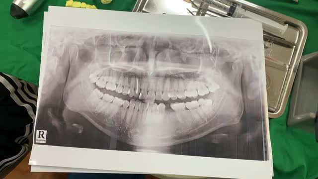 Lắp răng implant phục hình răng 35 cho anh khách hàng tại Nha Khoa Thuỳ Anh.