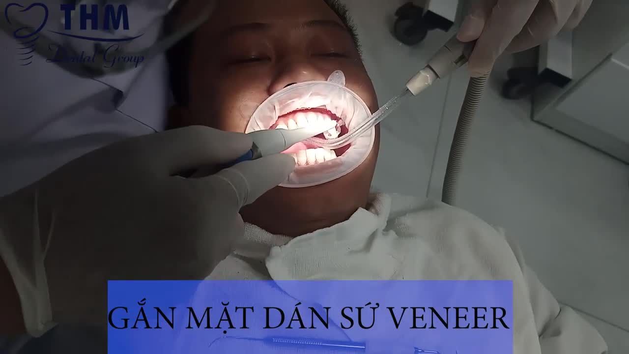 MẶT DÁN SỨ VENEER - GIẢI PHÁP THẨM MỸ RĂNG KHÔNG XÂM LẤN