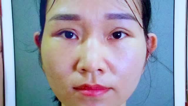Mắt lỗi hỏng do thẩm mỹ tại các cơ sở không uy tín bạn liên hệ ngay Dr.Hải Lê để có giải pháp khắc phục sớm nhất bạn nhé!