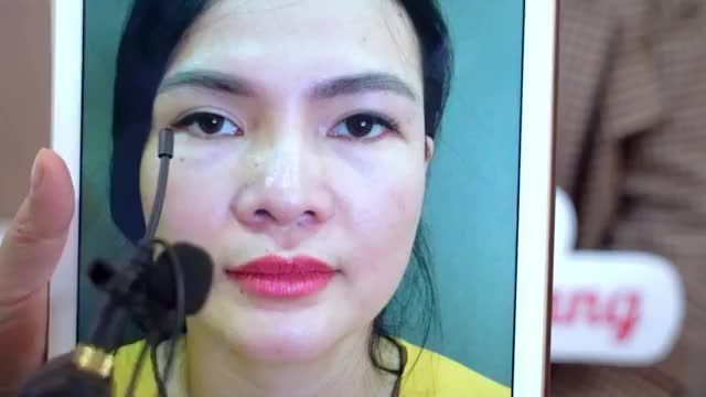 Mắt lỗi hỏng do thực hiện tại cơ sở không uy tín dẫn đến tình trạng nhược cơ sụp mí.... phải xử lý như thế nào?