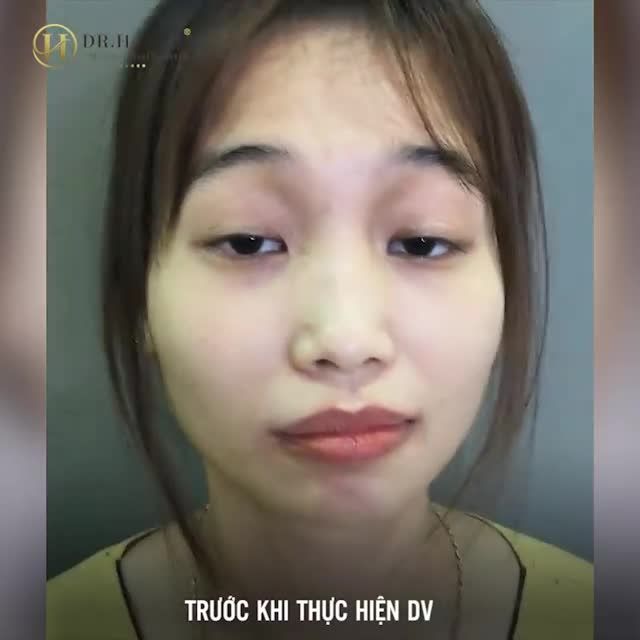 MẮT NHƯỢC CƠ NÂNG MI BẨM SINH TỪNG SỬA MÍ NHƯNG TIẾP TỤC LỖI