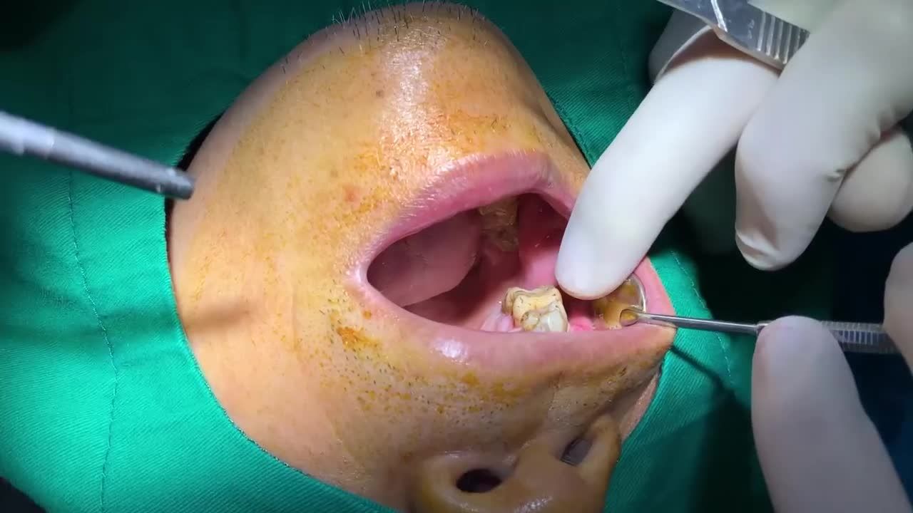 MẤT RĂNG VÀ HẬU QUẢ KHÓ LƯỜNG
