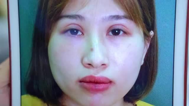 Mí sửa sau 7 ngày tại Dr.Hải Lê trông sẽ như thế nào, liệu có đẹp như mong đợi của khách hàng. BẤM XEM NGAY!