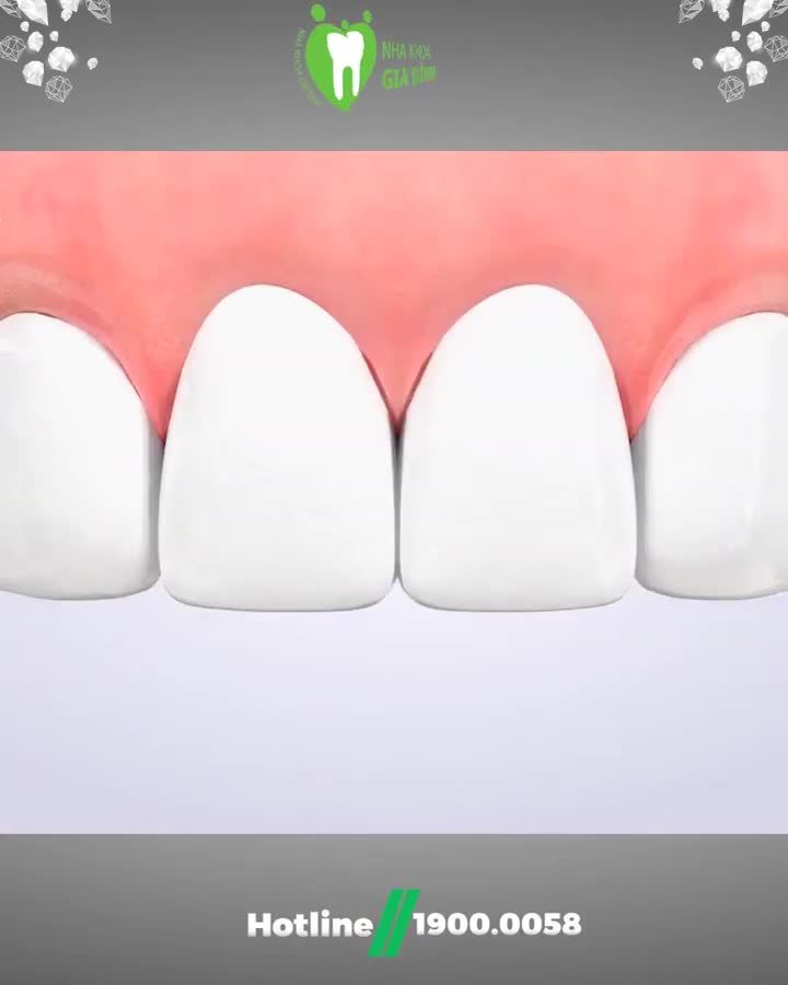 MÔ PHỎNG DÁN SỨ VENEER SIÊU MỎNG TẠI NHA KHOA GIA ĐÌNH
