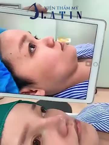 Mời cả nhà cùng ngắm kết quả ca mũi cấu trúc Sugiform kết hợp thu nền xương nhé!