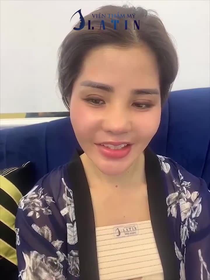 Mời cả nhà cùng ngắm kết quả sau 10 ngày của ca chỉnh sửa mũi tái cấu trúc lần 4 + cắt mí lần 2 của chị khách hàng siêu dễ thương