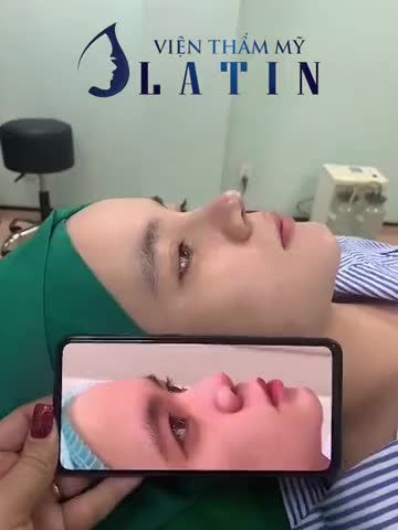 Mời cả nhà cùng xem và so sánh hình ảnh trước - sau của khách hàng sau ca nâng mũi bán cấu trúc