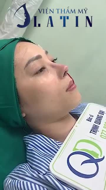 Một ca mũi đã nâng sụn nhân tạo cách đây 10 năm, bị lộ sóng, gồ, đầu mũi hếch, khuyết cánh mũi,...