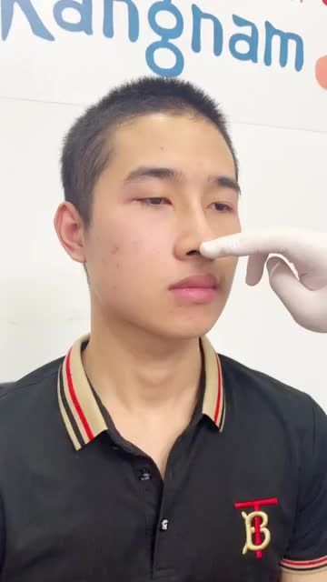 Mũi CAO - THON GỌN chỉ sau 10 ngày của anh chàng điển trai