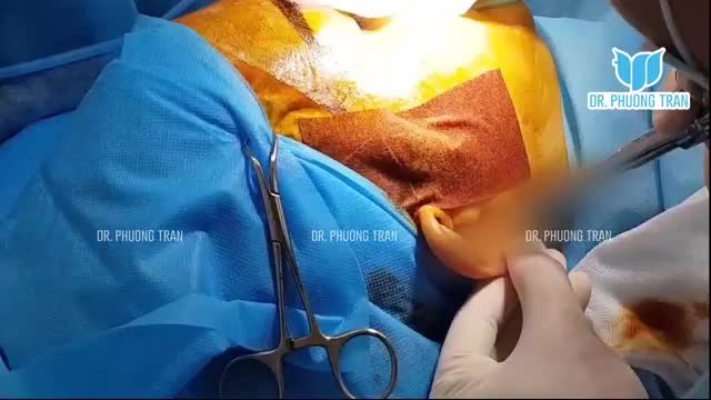 MŨI CẤU TRÚC ĐẸP TỰ NHIÊN NGAY SAU PHẪU THUẬT