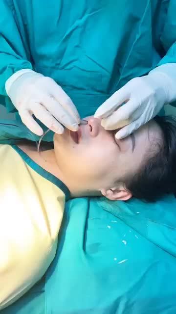 MŨI ĐẸP CHUẨN TỈ LỆ SAU NÂNG MŨI DIKA 3D