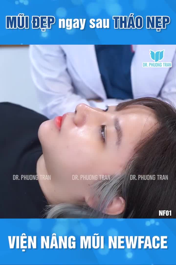 MŨI ĐẸP NGAY SAU THÁO NẸP LÀ CÓ THẬT!