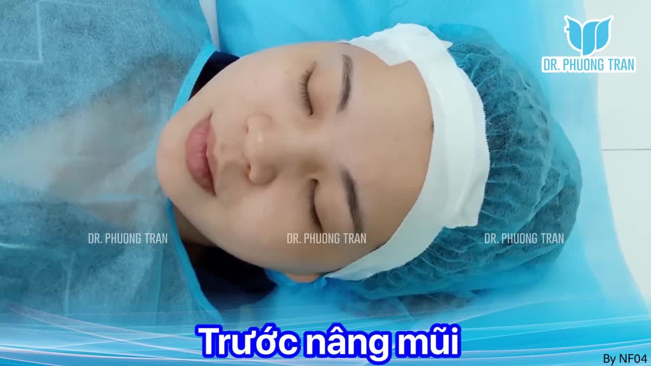 MŨI ĐẸP TỰ NHIÊN NGAY SAU PHẪU THUẬT
