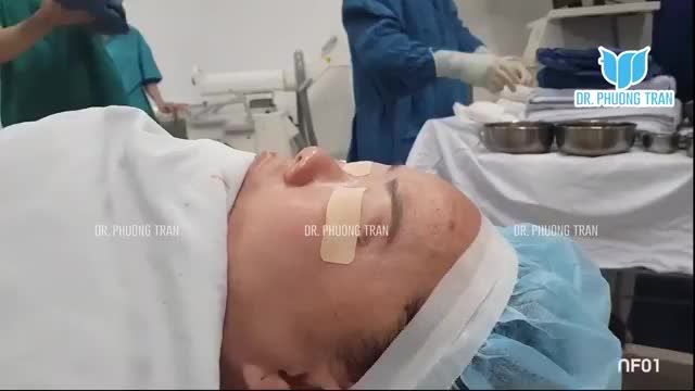 MŨI NGẮN, GẦN NHƯ KHÔNG CÓ SỐNG, DA MỎNG THÌ NÊN NÂNG MŨI THẾ NÀO?