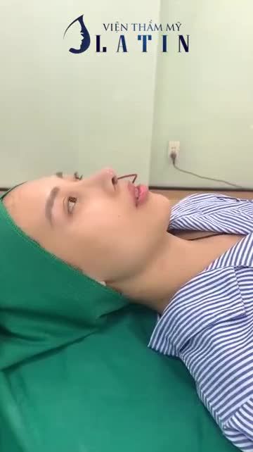 Mũi Tái Cấu Trúc Sửa Lại Lần 2 Cho Em Gái Hà Nội