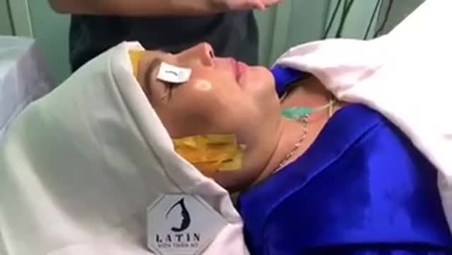 Mũi thấp tẹt, hếch thành mũi cao sang thanh tú sau Nâng mũi cấu trúc tại Latin